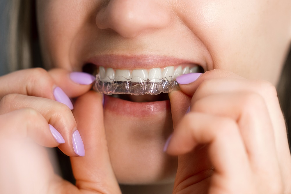 Clear dental aligners for a straighter smile at Sunrise Dental Clinic in Gig Harbor WA