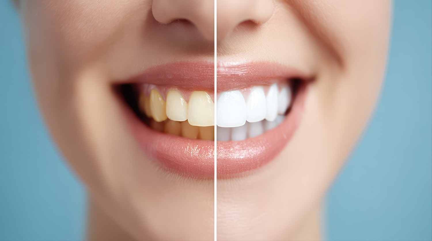 Before and after teeth whitening transformation at Sunrise Dental Clinic in Gig Harbor, WA for a brighter, confident smile